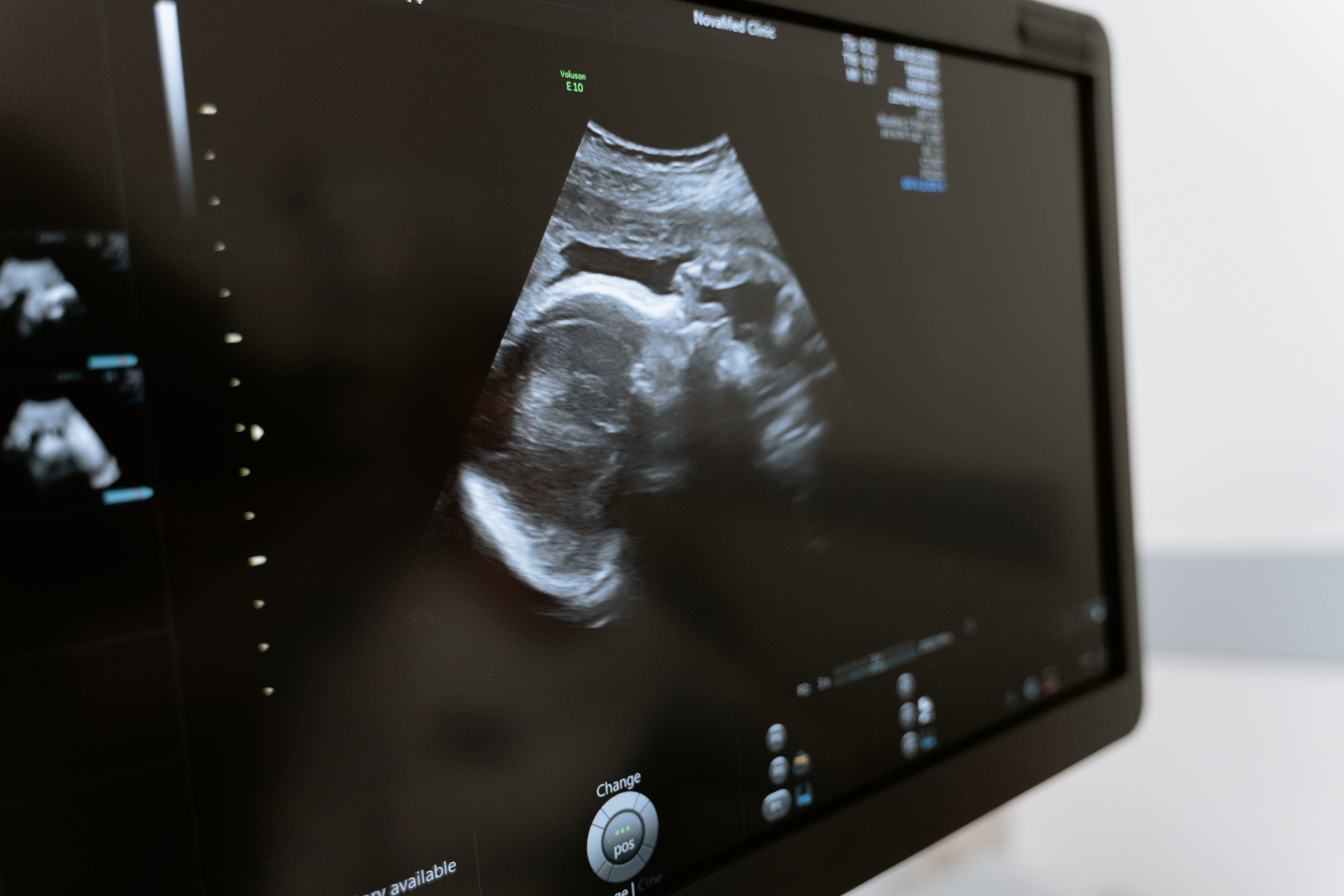 Ultrasound Scan